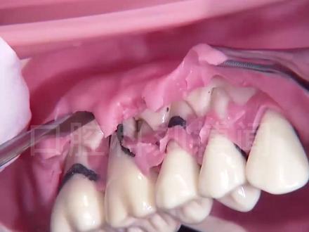 模型演示牙周炎手术,重度的牙周炎,可能需要做翻瓣刮治处理#口腔科刘博闻 @抖音小助手