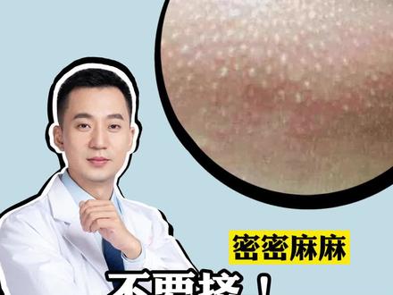 额头和下巴长了密密麻麻的#粉刺,化妆都这不掉,怎么办呢?#科普 #皮肤健康