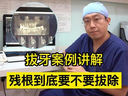 牙齿的残根到底要不要拔除?什么样的牙齿是不能保留的?#拔牙 #医学科普 #口腔科庄锐