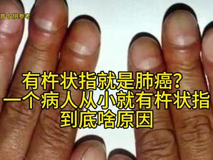有人说有杵状指就是肺癌,一个病人从小就有杵状指,到底啥原因?