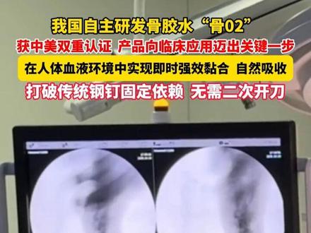 我国自主研发骨胶水“骨02”获中美双重认证,产品向临床应用迈出关键一步。 #健康 #骨胶水