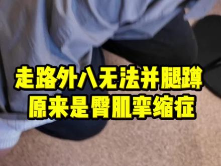 这位姑娘幼时臀部反复打针,患上了臀肌挛缩症,常年走路外八字,无法并腿下蹲,生活深受困扰。
臀肌挛缩症具有明显的发病地域特点,国内高发、国外罕见,绝大多数病例都源于儿童时期反复臀部肌肉注射。
我这里每年完成臀肌挛缩关节镜微创手术600例左右。开展双后入路特色微创松解术,手术创伤小、松解彻底,临床康复效果优异,帮助众多患者矫正异常步态,恢复正常下蹲与肢体功能。
#硬核健康科普行动 #抖出健康知识宝藏 #骨科袁锋 #臀肌挛缩 #上海六院