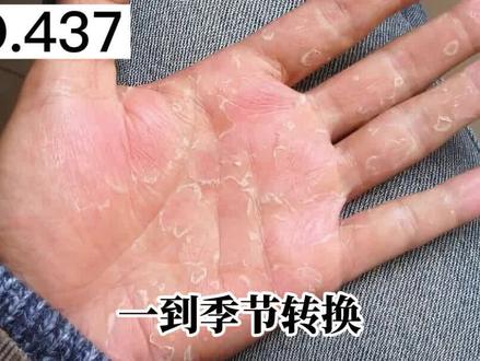 手掌手指反复脱皮,死皮撕不干净,手摸起来很粗糙,教你一个办法解决 #剥脱性角质松解症 #脱皮 #科普
