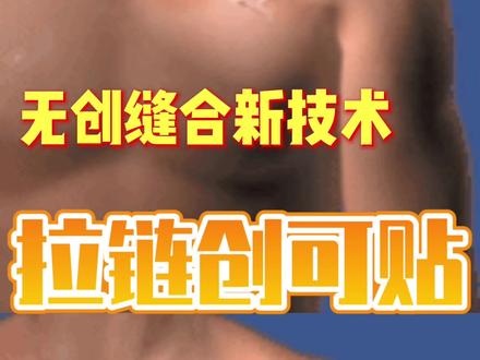 #拉链式创可贴 是一种新型#外伤缝合技术,可以有效避免运动造成的伤口疼痛和缝线带来的#疤痕增生 ,相关产品现已引入国内,建议家中常备。