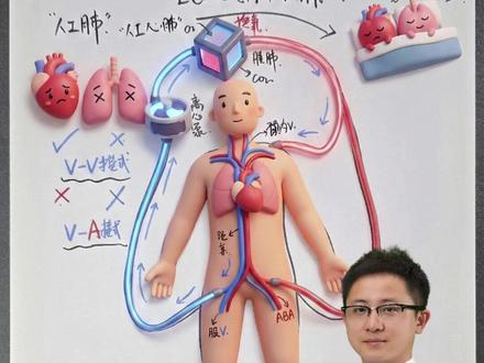 ICU里的救命神器ECMO到底是什么?这台机器凭什么这么贵 #抖音出品你好急诊医生#医生科普藏在身边的隐形杀手#ECMO #在急诊放弃对妈妈的治疗有多痛 #送ta上精选