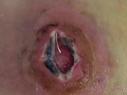 腿部囊肿手术,黑色的是坏死皮肤,无痛换药!消炎消肿!