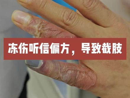 冻伤听信偏方,导致截肢 #冻伤 #辟谣 #烧伤科 #医学科普 #土方法