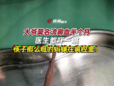 一老人莫名流鼻血半个月,原因竟是鼻腔里“养”了只蚂蝗 。#太可怕了