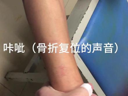 Smith骨折手法正骨,#中医正骨 #正骨 #骨科 #桡骨骨折 #有一种疼叫做看着都疼