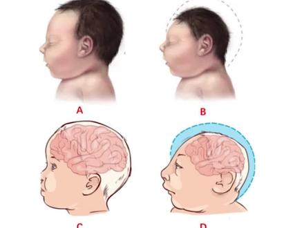 #头小 和#小头 畸形如何区分?这个视频教你!#宝宝头型 #关爱儿童健康