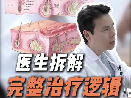 如何避免“化脓性汗腺炎”反复发作 #化脓性汗腺炎 #皮肤外科彭建中 #脓肿发炎 #化脓性汗腺炎手术 #杭州市第三人民医院
