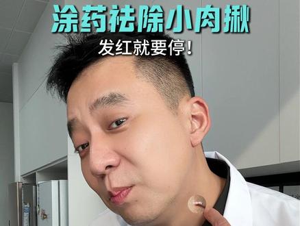 脖子小肉揪,用错药真会烂脖子啊!手把手教会你! #丝状疣 #传染 #健康科普 #皮肤科 #保姆级教程