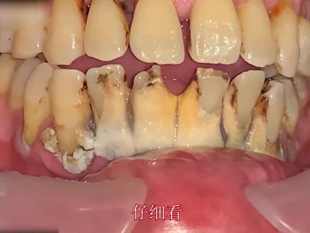 小伙每天嚼槟榔抽烟,牙齿漆黑结石,拖泥憋气式修整解压又下饭 #洗牙 #解压视频 #纪录片解说