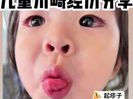 2岁宝宝高烧反复 | 川崎经验分享#经验分享 #母婴知识 #宝宝成长