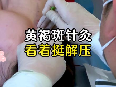 黄褐斑针灸看着有多解压 #黄褐斑 #针灸调理 #中医刘一鸣 #硬核皮肤健康宝典 #硬核健康科普行动