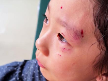 女儿被流浪狗咬了,真怕有什么后遗症 #八小只#流浪狗#狗咬人事件