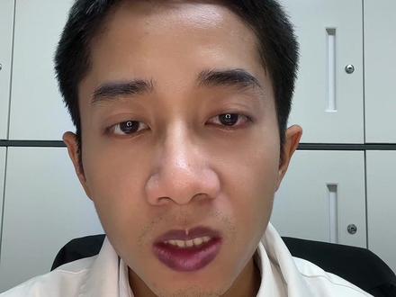 咽痛,张不开嘴,说话含糊是怎么了?扁桃体周围脓肿的治疗。#喉咙痛 #扁桃体 #会厌 #穿刺 #脓肿