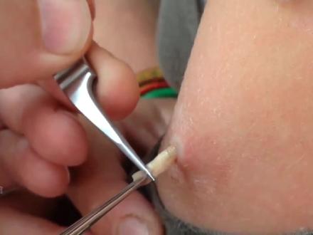 去除马蝇幼虫过程可以说很解压,天气转暖,尽量避免沾惹到这东西#马蝇幼虫 #解压视频 #强迫症看了很享受