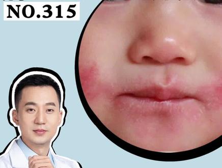 宝宝嘴巴周围出现红斑脱屑,经常忍不住搔抓,试试这个方法#口周湿疹 #湿疹 #皮肤 #科普