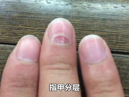 指甲分层是怎么回事?#指甲