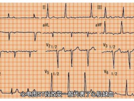 心电图提示ST段异常改变,你知道什么意思吗?
