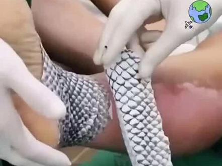 研究发现,罗非鱼皮经过特殊处理对治疗烧伤有显著效果,已进入临床试验。