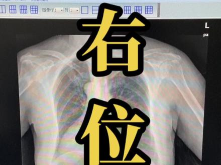 #右位心
心脏在胸腔的右侧,其心房 、心室 和大血管的位置宛如正常心脏的镜中象,亦称为#镜像右位心。常伴有 内脏转位 ,但亦可不伴有内脏转位。