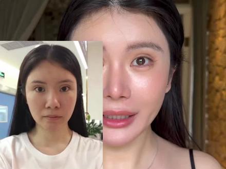 缩鼻头 缩鼻翼 6年了 没有任何痕迹 #缩鼻头 #缩鼻翼 #鼻翼缩窄 #鼻头缩小 #鼻子