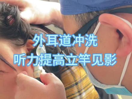 年轻人听力减退,很可能是耳屎或大量分泌物完全堵塞外耳道#听力减退#耳聋#外耳道冲洗 #耵聍栓塞