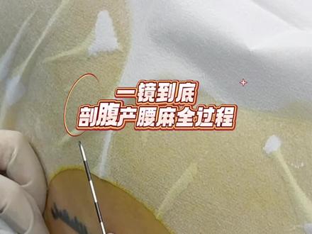 这个麻醉师好温柔 #产房故事 #尽职尽责的好医生 #生命的诞生