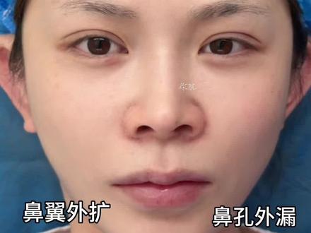 鼻翼宽大、嘴角下垂、人中偏长综合改善案例分享#缩鼻翼#鼻翼缩小#嘴角上扬 #人中窝加深 #徐丽芬