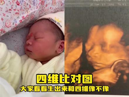 顺产头部挤压变形多久可以恢复?