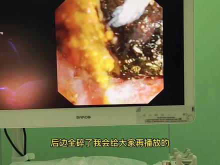 肝内胆管结石碎石#健康守护计划 #医学科普 #微创手术 #健康科普