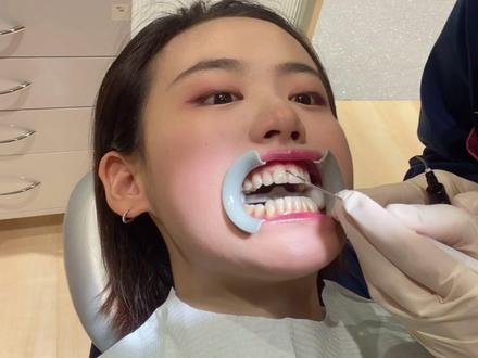 美食博主能通过牙齿冷光美白,逆袭获得一口大白牙吗?#口腔健康 #美白牙齿 #保护牙齿 #变美逆袭 #爱护牙齿 #美牙修复 #大白牙 #口腔科普 #口腔 #记得微笑 #抖音小助手