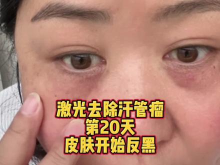 激光去除汗管瘤第20天 皮肤开始反黑 担心留疤 #汗管瘤 #激光 #治疗 #皮肤病医院 #留疤 #皮肤反黑 #复发 #创作灵感 #抖音小助手 #dou+小助手