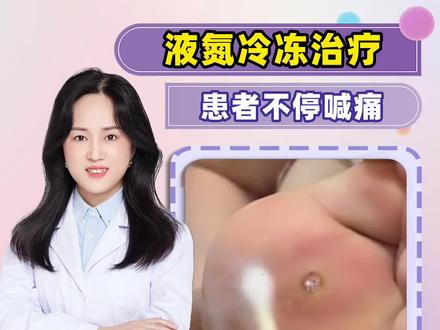 -196℃冻皮肤有多痛?冷冻治疗让美女直接泪奔#液氮冷冻 #跖疣