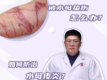 如何预防水母皮炎? #医学科普 #健康科普 #皮肤 #医生 #皮肤李博士