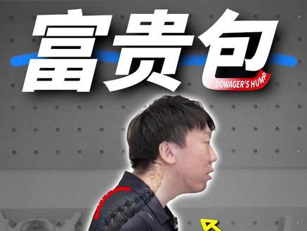 颈后大包——富贵包|从康复的角度层层剖析根本原因+改善思路 #抖出健康知识宝藏 #医学科普 #富贵包 #体态纠正 #运动康复