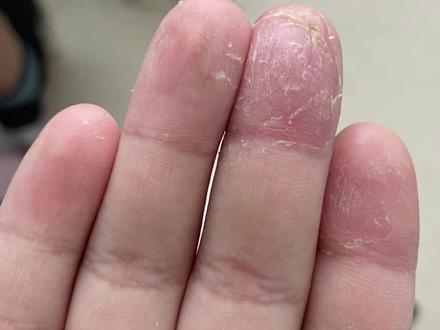 孩子手总脱皮,这些事情要少做#医学科普 #健康科普