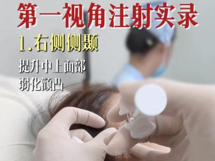 沉浸式体验全脸微调,第一视角注射全过程,全长4分钟,只加速,不剪辑 #全脸提升 #变美 #郑州张歌 #郑州注射医生#面部年轻化
