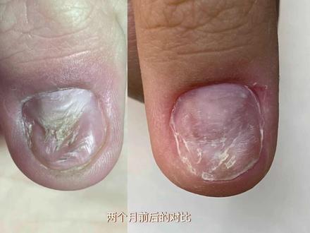 啃出坑的指甲后续来啦!这可不是灰指甲!看清楚哦!#啃咬甲 #啃咬甲矫正 #啃指甲的习惯怎么改 #美甲vlog #啃指甲