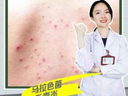 🤔背上的痘痘记得这样祛除⁉️#痘痘#皮肤管理#马拉色菌#毛囊炎#医学科普@抖音小助手