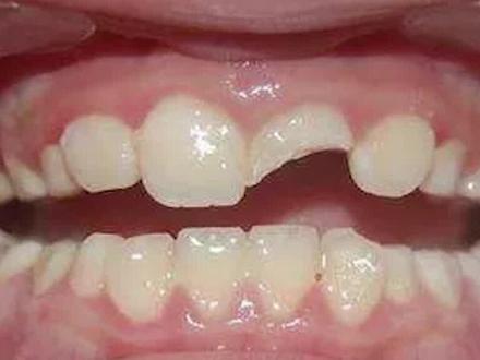 牙齿烂一半了,留还是不留,看到最后你就知道了!#牙齿健康 #牙齿