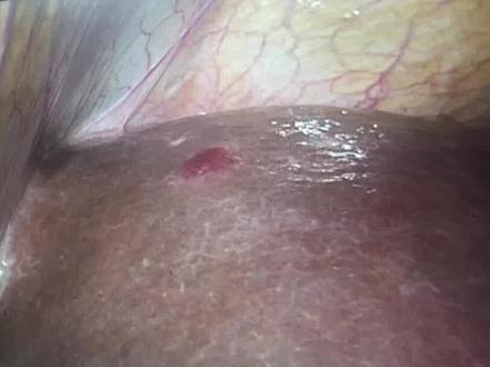 腔镜探查见:肝血管瘤、胃壁血管瘤、胆囊腺肌症 #腔镜