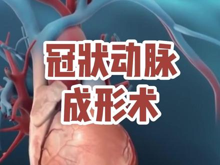 广西表哥版,冠状动脉成形术3D动画演示。#冠心病 #医学科普 #广西