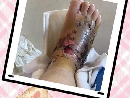 这下真的要截肢了#后续#鲨鱼#马尔代夫#截肢