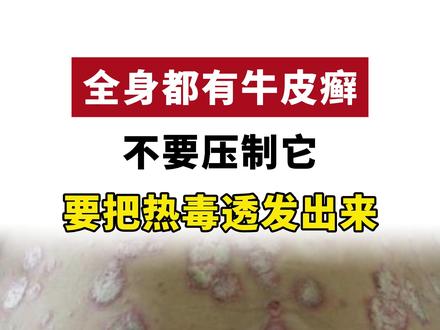 全身都有牛皮癣 不要压制它 要把热毒透发出来 #牛皮癣 #银屑病 #银屑病小知识
