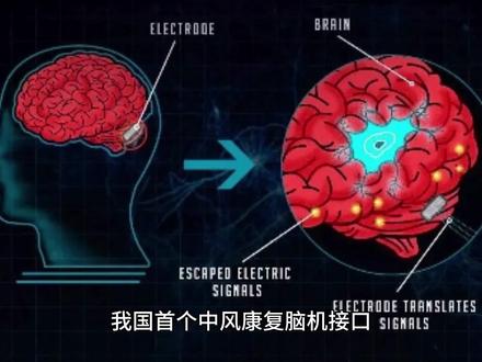 我国首个中风康复脑机接口临床试验进入冲刺阶段 #脑机接口技术 #科学 #生命科学