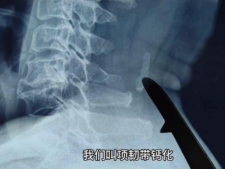 转动头部时颈椎后方沙沙响,这是早期#颈椎病 的信号,要重视!#颈肩痛 #手麻#脊髓型颈椎病 #健康科普