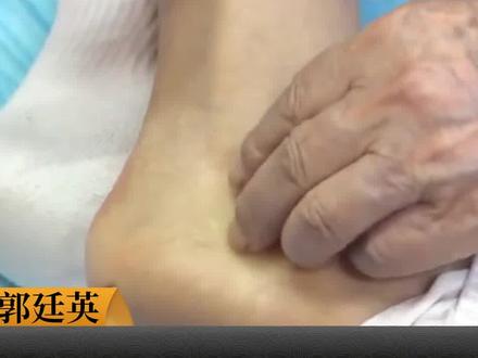 照海和教材不同的取穴位置 #郭廷英#针灸学习#郭帅#中医传承#照海